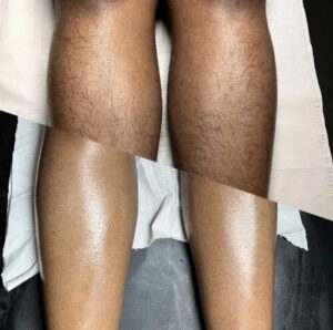 PANSLY Hair Removal Spray –30 ML | 🎉 𝗕𝗨𝗬 𝟭 𝗚𝗘𝗧 𝟭 𝗙𝗥𝗘𝗘 🎉 photo review