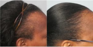 Batana Natural Hair Growth Oil |🎁 BUY 1 GET 1 FREE photo review